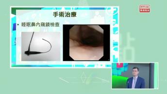 香港耳鼻喉及頭頸外科學會系列 - 睡眠窒息症的新式治療